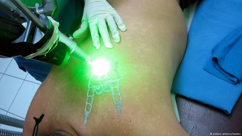Terapi Laser untuk Tatto dan Tanda Lahir